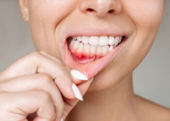 Ulcerative stomatitis on the gums. Gum inflammation. Cropped shot of a young woman showing red bleeding gingiva with an ulcer isolated on a gray background. Close up. Dentistry, dental care