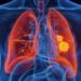 Lung cancer, illustration